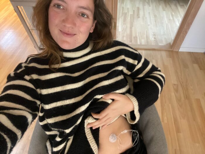 Mathilde Fonager Larsen med sin nye insulinpumpe